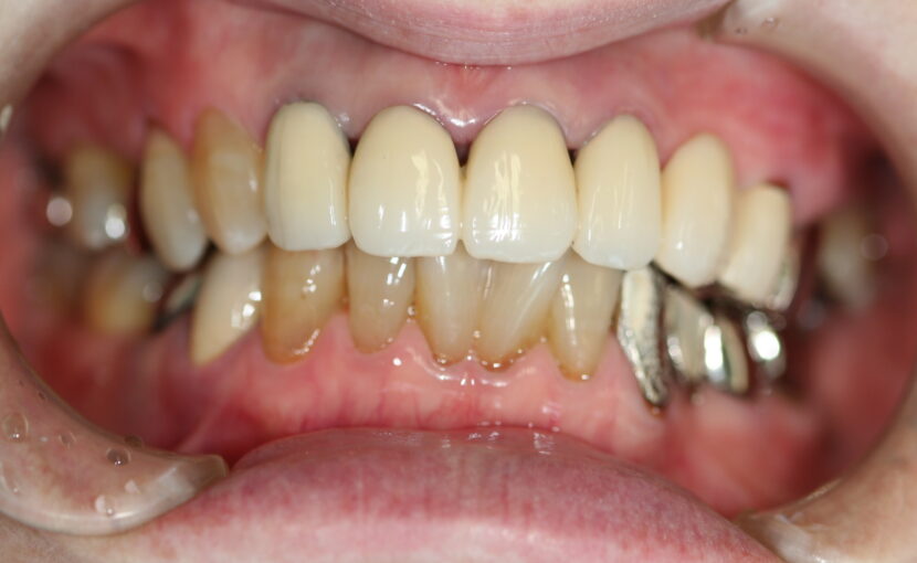 症例紹介｜審美歯科｜佐賀｜船津歯科クリニック