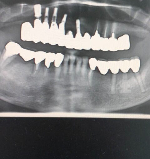 症例紹介｜インプラント｜佐賀｜船津歯科クリニック