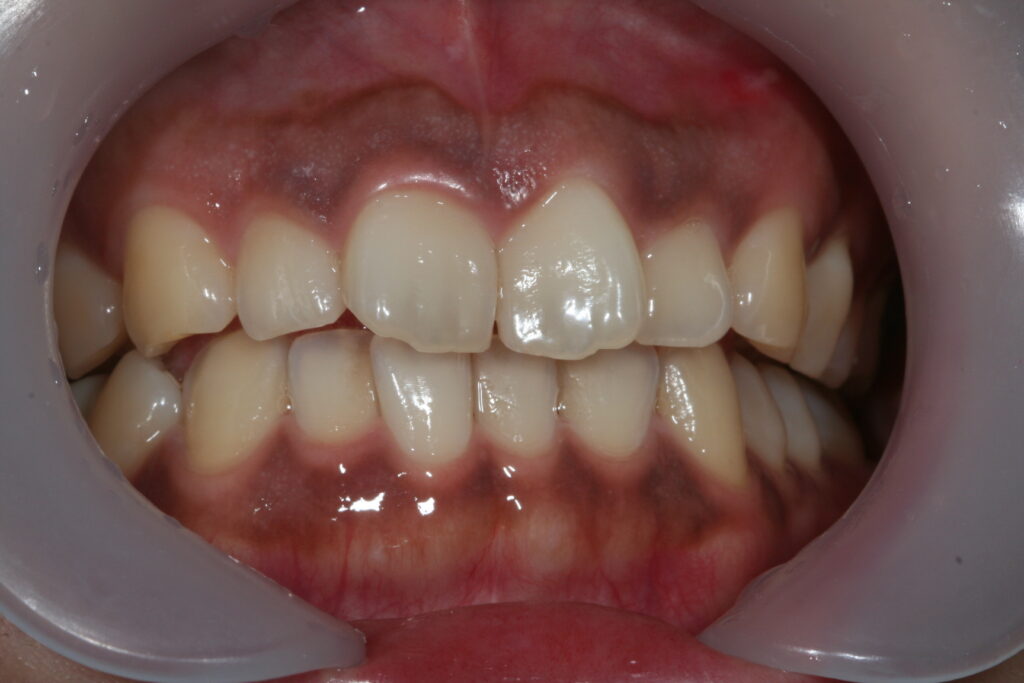 院長ブログ｜佐賀｜船津歯科クリニック