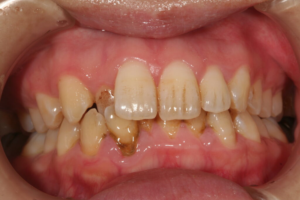 症例紹介｜メインテナンス｜佐賀｜船津歯科クリニック