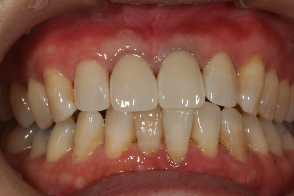 症例紹介｜審美歯科｜佐賀｜船津歯科クリニック