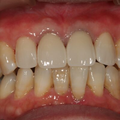 症例紹介|審美歯科|佐賀|船津歯科クリニック