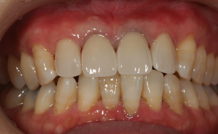 症例紹介｜審美歯科｜佐賀｜船津歯科クリニック