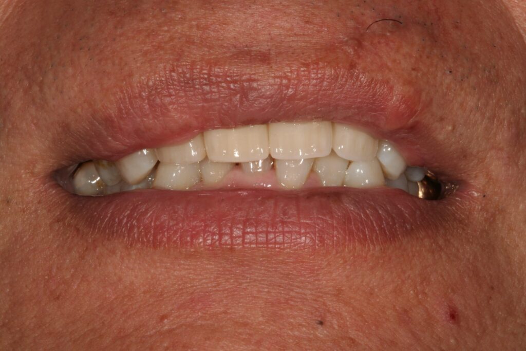 症例紹介｜審美歯科｜佐賀｜船津歯科クリニック