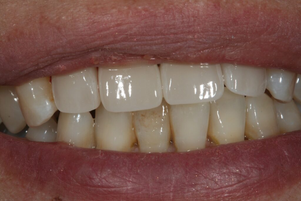 症例紹介｜審美歯科｜佐賀｜船津歯科クリニック