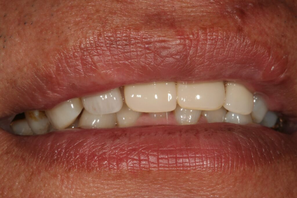 症例紹介｜審美歯科｜佐賀｜船津歯科クリニック