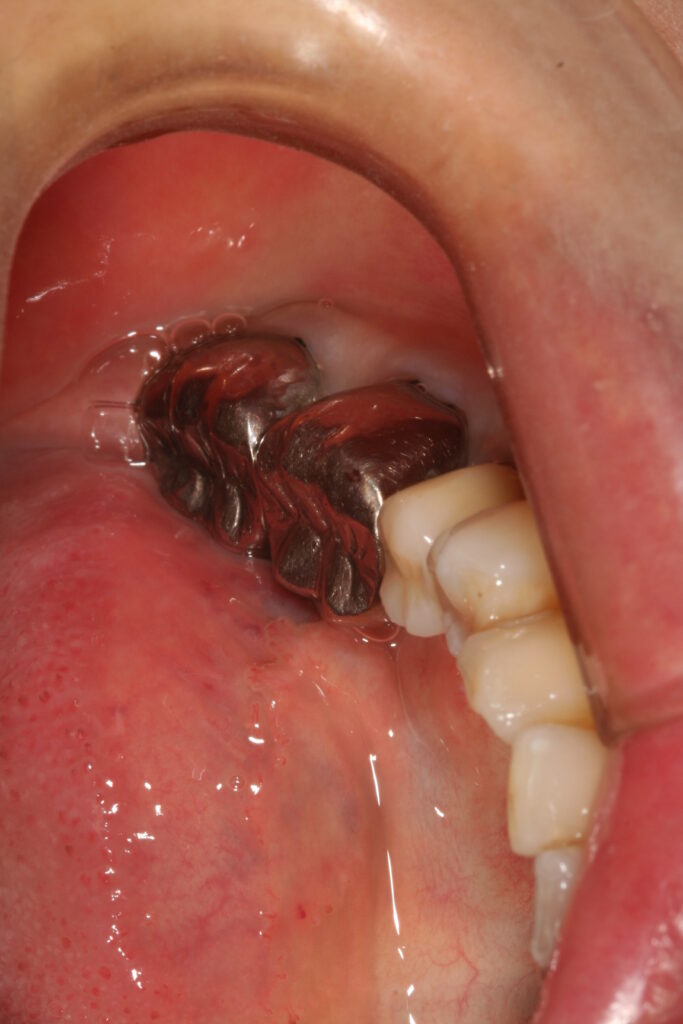 症例紹介｜セレック｜佐賀｜船津歯科クリニック