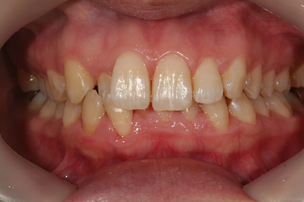 症例紹介｜メインテナンス｜佐賀｜船津歯科クリニック