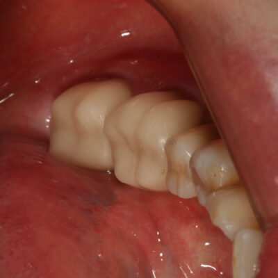 症例紹介|セレック|佐賀|船津歯科クリニック