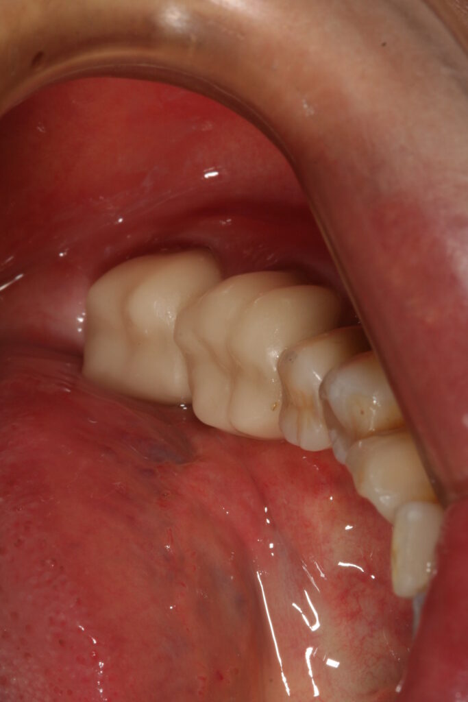 症例紹介｜セレック｜佐賀｜船津歯科クリニック