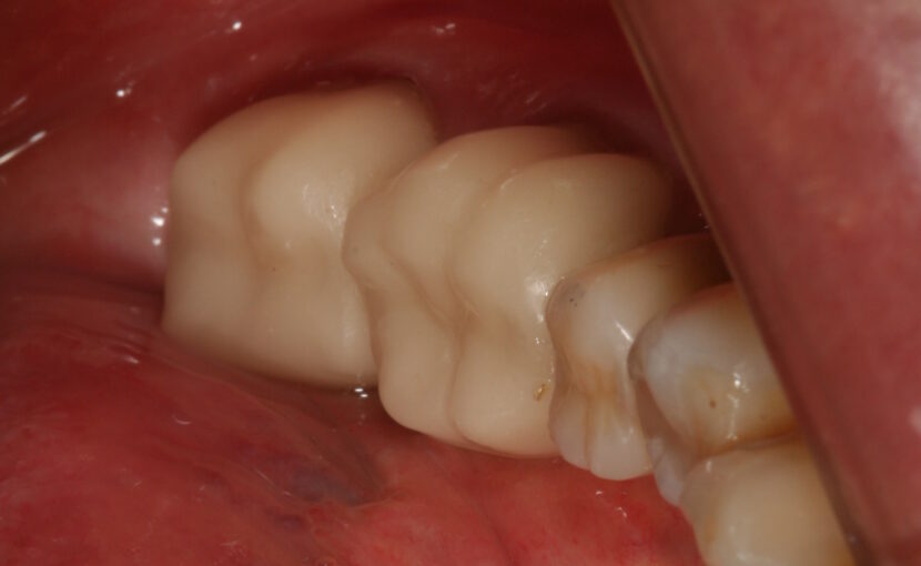 症例紹介｜セレック｜佐賀｜船津歯科クリニック