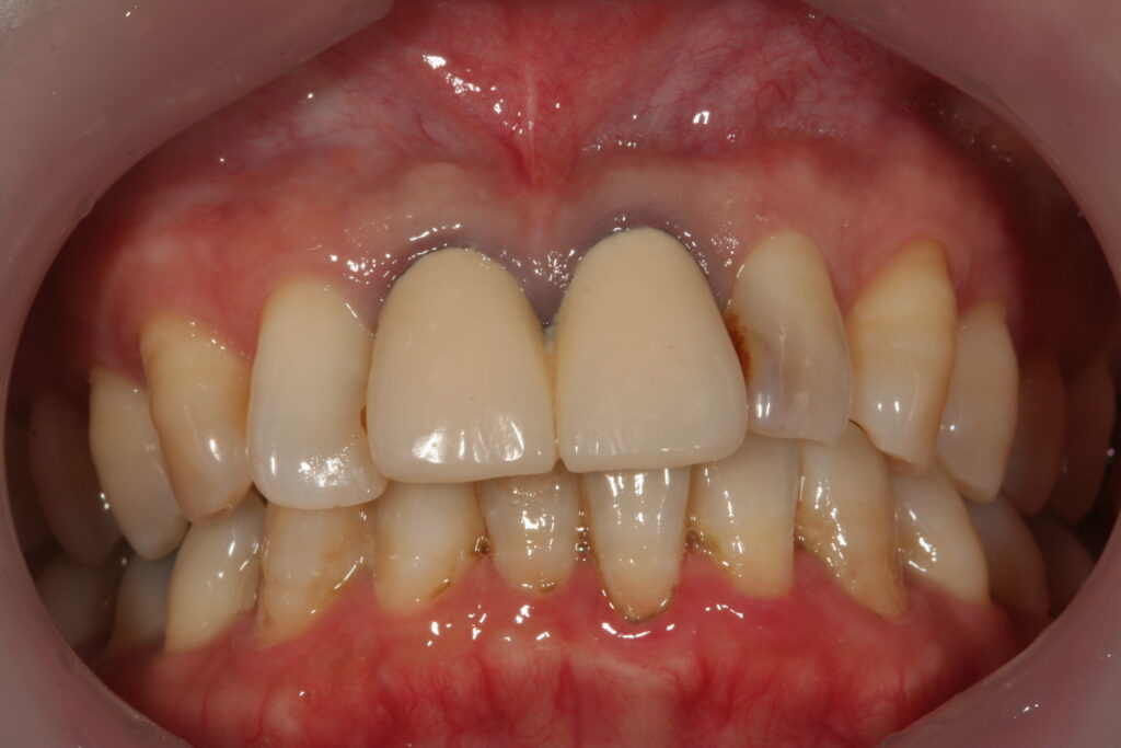 症例紹介｜審美歯科｜佐賀｜船津歯科クリニック