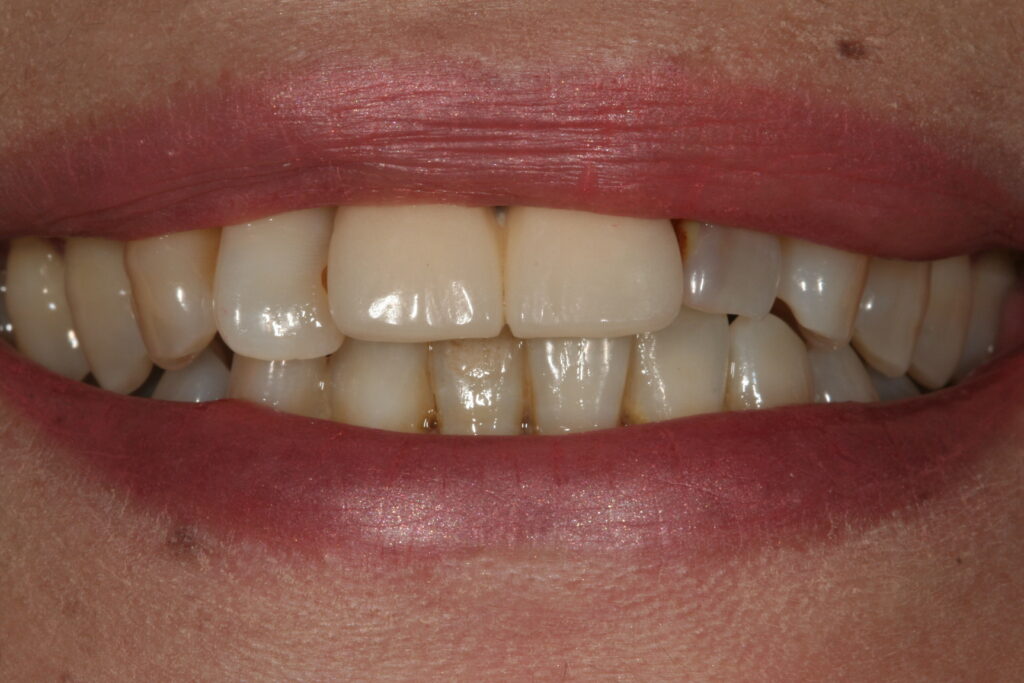 症例紹介｜審美歯科｜佐賀｜船津歯科クリニック